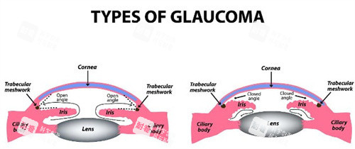 开角型和闭角型青光眼