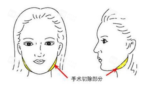 面部磨骨手术示意图