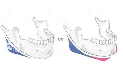 磨骨前后对比示意图