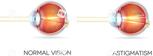 正常眼镜和散光眼睛区别