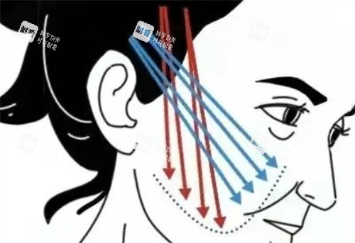 中下面面部提升的位置