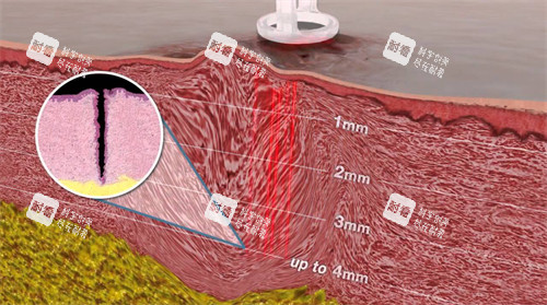 皮肤内的疤痕纹理 皮肤内的疤痕纹理