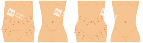 腹壁成形可改善的腰腹状态