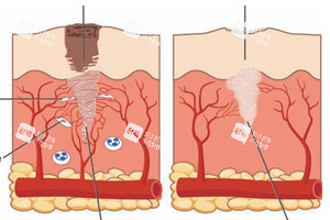 不同情况的疤痕在皮肤上的表现