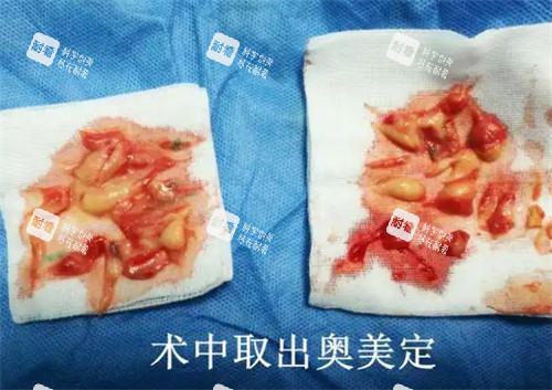 术中取出的奥美定