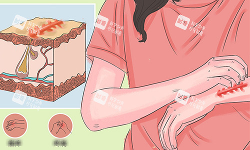 疤痕增生之疤痕疙瘩的动画图