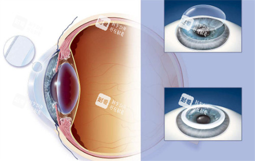 角膜移植手术过程图解