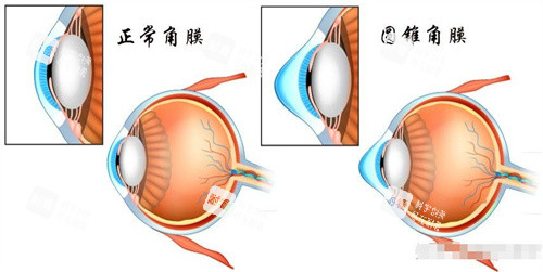 正常角膜与圆锥角膜对比图
