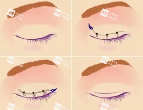 双眼皮手术示意图