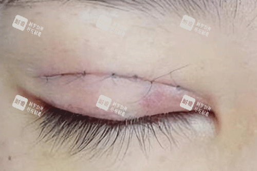 双眼皮疤痕明显照片