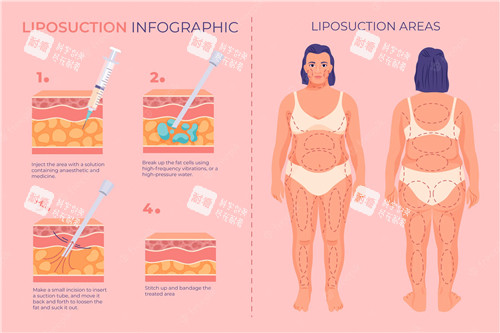 吸脂前后对比照 吸脂前后对比照