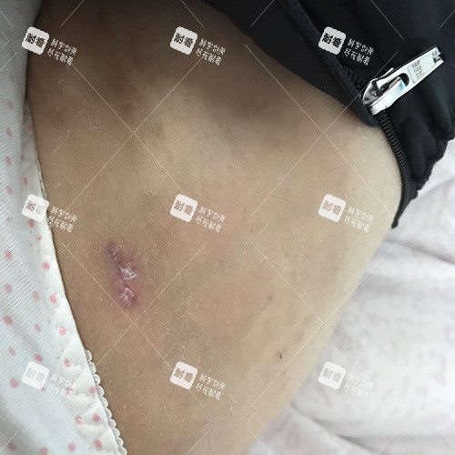 大腿吸脂伤口 大腿吸脂伤口