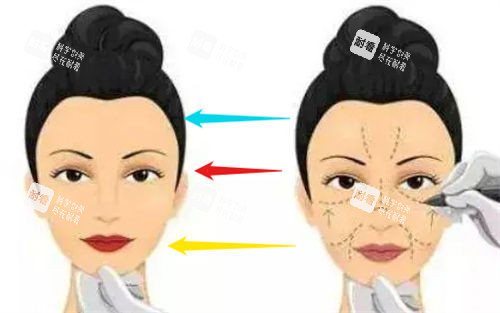 手术面部画线示意图.jpg 手术面部画线示意图.jpg