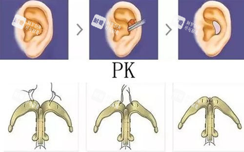 耳软骨支架隆鼻图 耳软骨支架隆鼻图