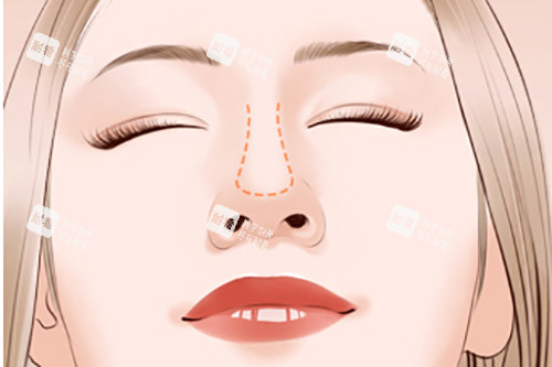 隆鼻鼻梁位置示意图 隆鼻鼻梁位置示意图