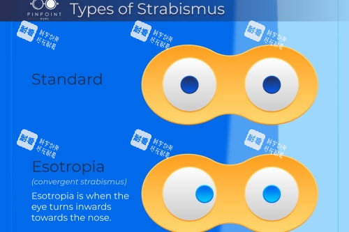正常眼对比斜视眼 正常眼对比斜视眼