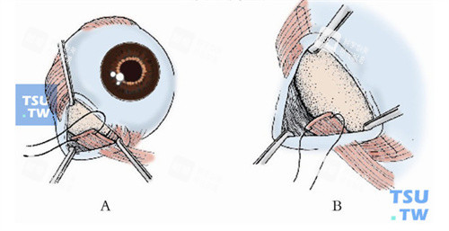 斜视手术动画图 斜视手术动画图