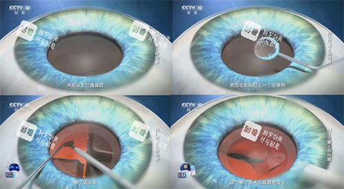 白内障手术流程简图 白内障手术流程简图