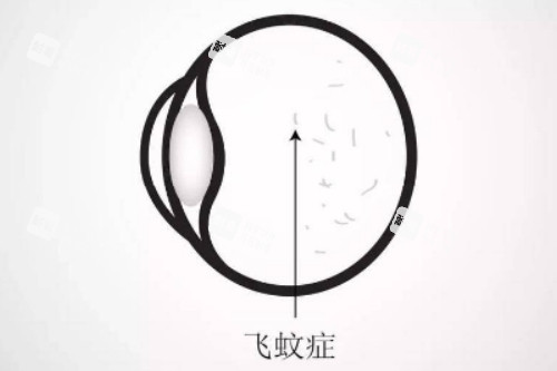 飞蚊症卡通图片展示