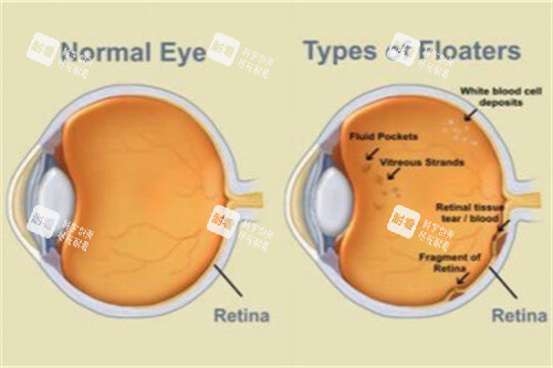正常眼球与飞蚊症眼球对比