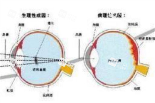 不同原因飞蚊症对比