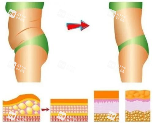 吸脂过程前后示意图