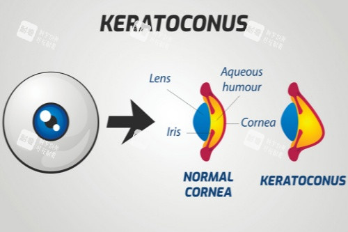 圆锥角膜结构示意