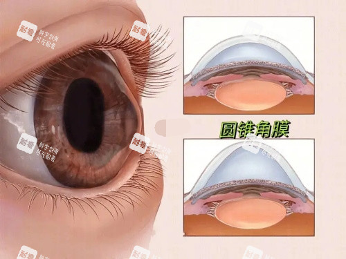 圆锥角膜的角膜状态
