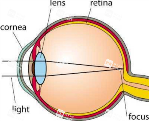 圆锥角膜的样子图片