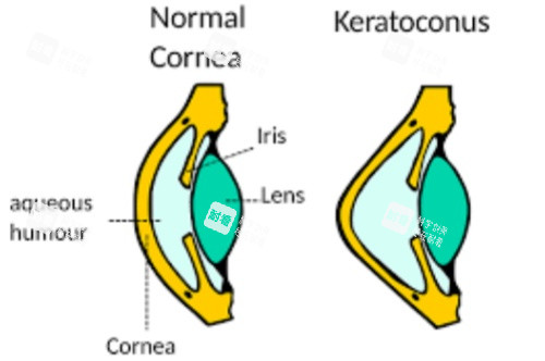 圆锥角膜对比图