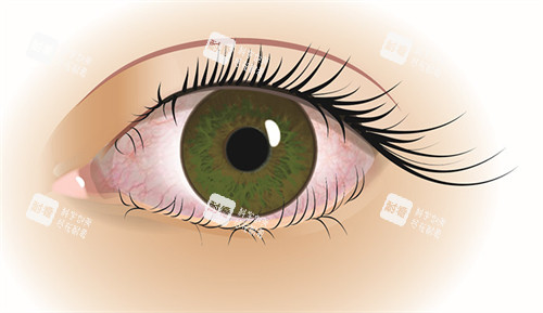 倒睫睫毛刺激眼睛 倒睫睫毛刺激眼睛