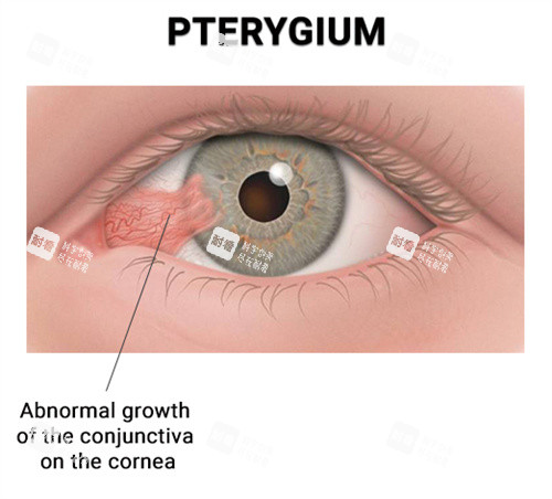 翼状胬肉对眼睛的影响 翼状胬肉对眼睛的影响