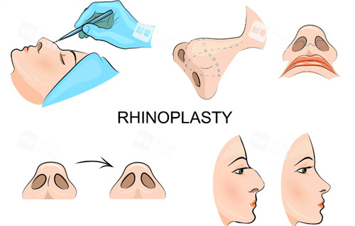隆鼻过程图示 隆鼻过程图示