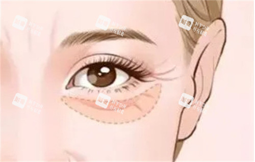 眼袋形成的衰老 眼袋形成的衰老