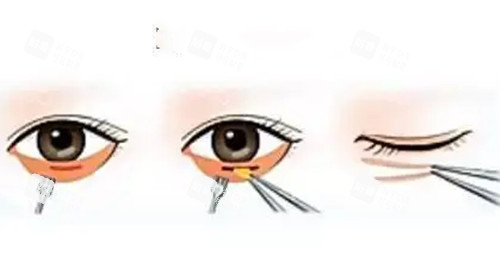 内切法祛眼袋简易步骤示意图 内切法祛眼袋简易步骤示意图