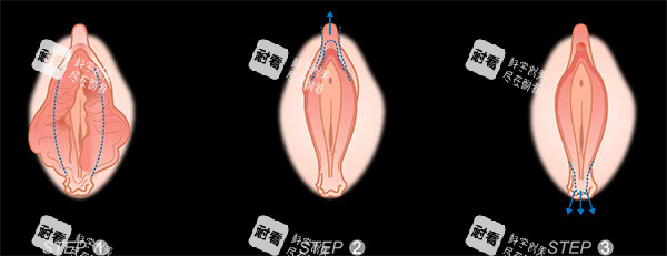 阴唇塑造照片 阴唇塑造照片