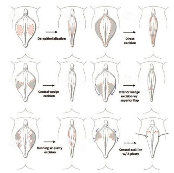 私密阴唇手术方法照片 私密阴唇手术方法照片