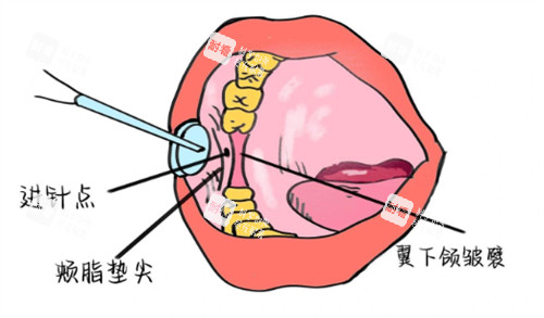 牙周韧带内注射麻醉 牙周韧带内注射麻醉