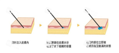 注射玻尿酸的原理 注射玻尿酸的原理