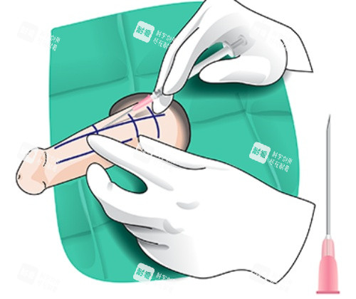 玻尿酸增粗漫画示意图 玻尿酸增粗漫画示意图