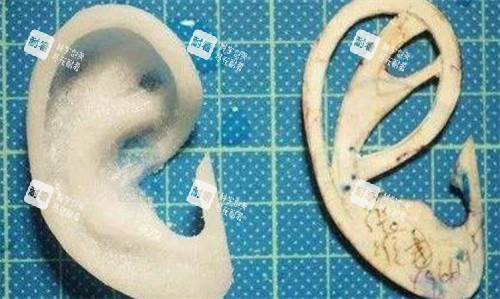 Medpor人工支架耳再造手术 Medpor人工支架耳再造手术