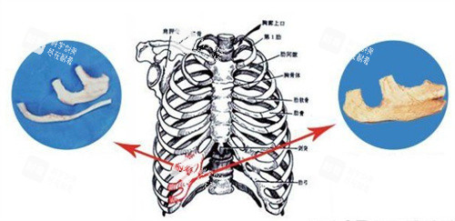 耳再造手术自体肋软骨 耳再造手术自体肋软骨