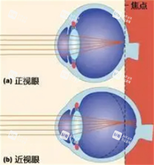 正常眼睛和近视眼镜的不同 正常眼睛和近视眼镜的不同