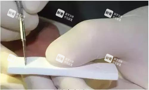 隆鼻手术雕刻中的膨体 隆鼻手术雕刻中的膨体