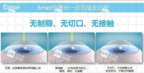smart全激光手术过程图 smart全激光手术过程图