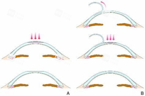 smart手术示意图 smart手术示意图
