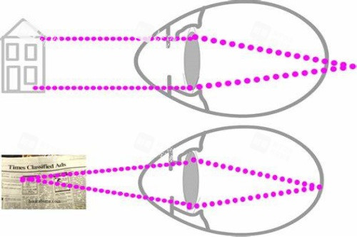正常眼与远视眼对比