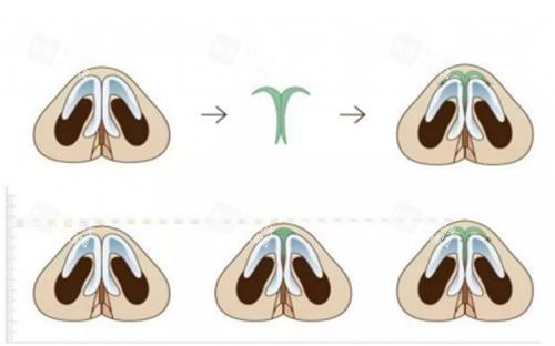 隆鼻流程示意图