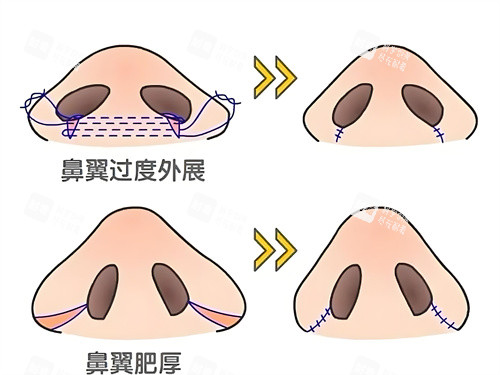 鼻翼缩小手术方式动画图