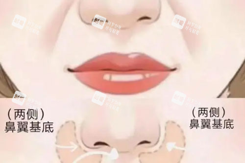 鼻翼、鼻基底卡通图